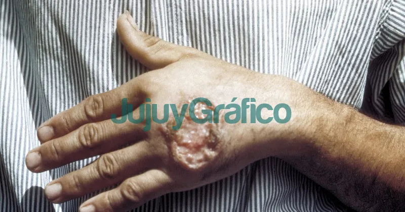 Leishmaniasis, la enfermedad que un “flebótomo” transmite a animales y humanos 2 Leishmaniasis