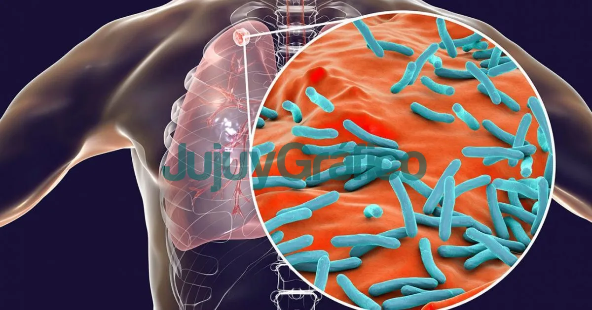 Encuentro virtual sobre tuberculosis 1 tuberculosis pulmonar
