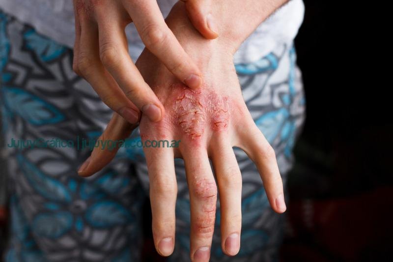"Mi Psoriasis": Una Plataforma para Acompañar a Pacientes con esta Enfermedad Crónica 1 Closeup men itching and scratching by hand. Psoriasis or eczema on the hand. Atopic allergy skin with red spots Una plataforma para acompañar a pacientes con esta enfermedad crónica